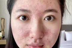 原创15岁女儿看皮肤却被开避孕药，妈妈怒气冲冲问为什么？医生的一番解释让妈妈羞惭不已，连连道谢
