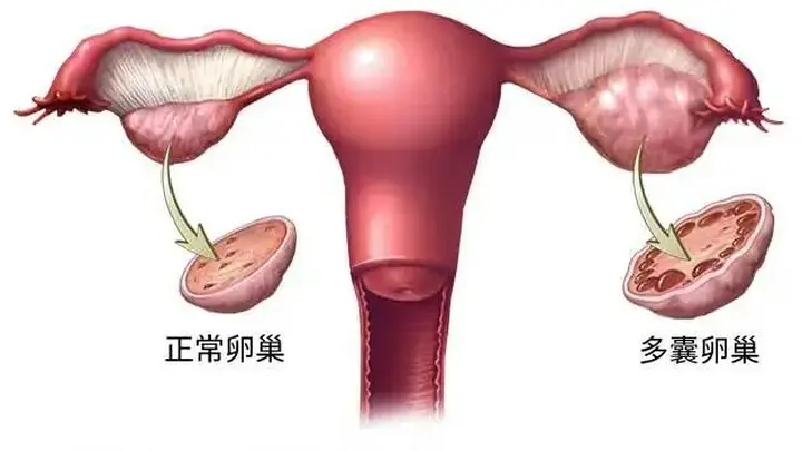 终于改名!这个病困扰全球1.7亿女性,却被“叫错”90年