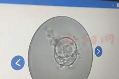 河南洛阳一女子婚后多年未孕，就医意外查出嵌合体，竟同时存在男女性染色体系统