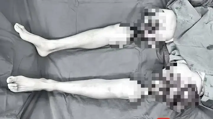 男子双大腿被绞断完全分离,经手术重新“接”回