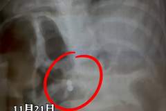 三岁男童误吞磁力珠奶奶轻视 医生邻居紧急提醒需手术