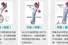 备孕两年无果，28岁杭州男子傻眼：这里竟藏了一窝“蚯蚓”！医生：千万别小看了