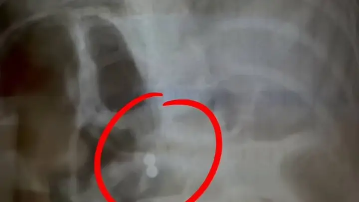 三岁男童误吞磁力珠奶奶轻视 医生邻居紧急提醒需手术